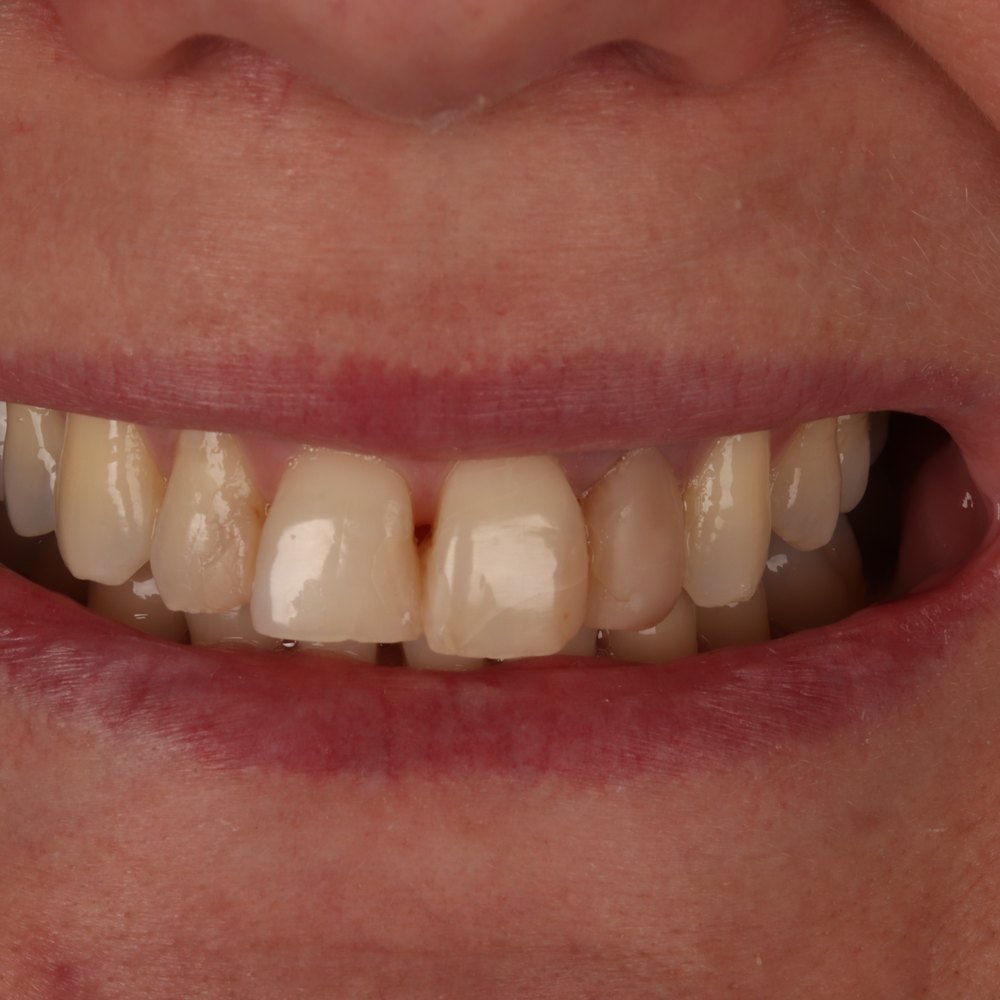 Sorriso da paciente Maria Cristina antes do tratamento na Oral Unic Dourados